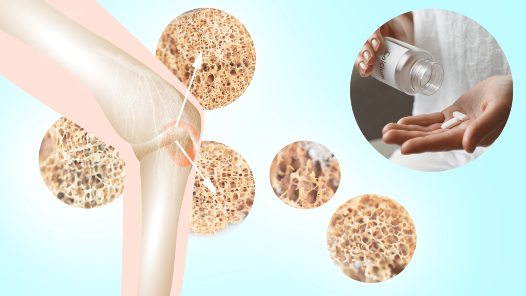 Benefits of Calcium Supplements for Bone Health - Natural